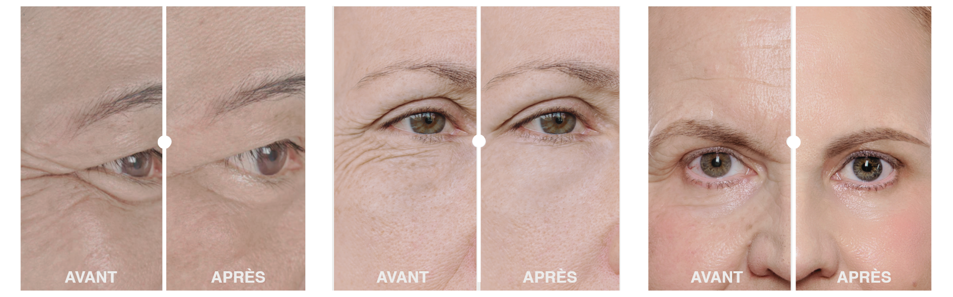 Soin contour des yeux – réduction visible des poches et cernes avant/après