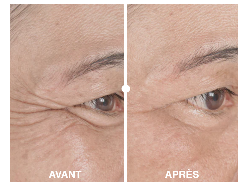 Résultats avant et après utilisation des soins Belle après 40 ans, peau lissée et éclatante